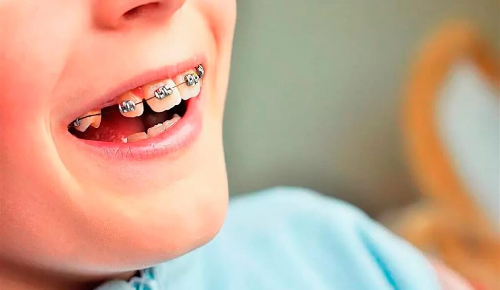 تقويم الأسنان للأطفال