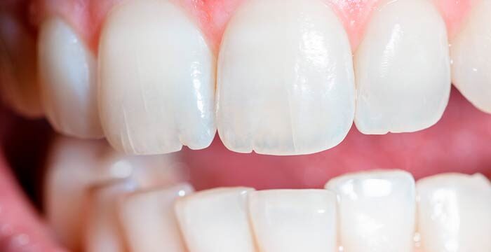 علاج تآكل الأسنان – الأسباب والحلول الحديثة